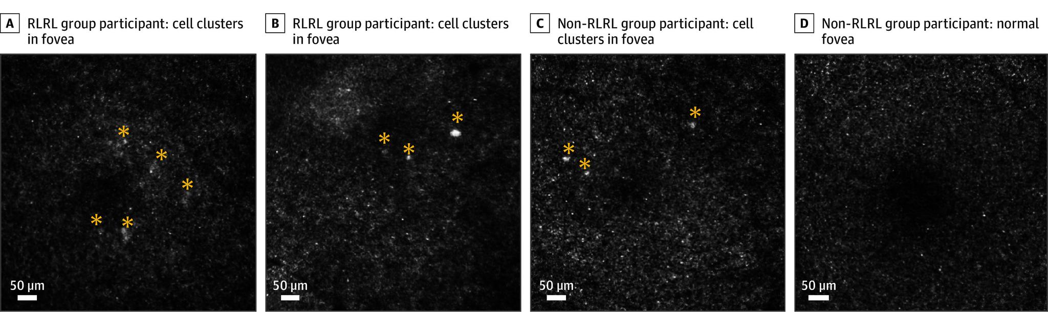 https://cdn.ncbi.nlm.nih.gov/pmc/blobs/886a/12022868/ce761091af4a/jamaophthalmol-e250835-g002.jpg