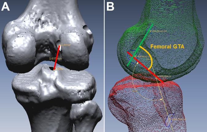 https://cdn.ncbi.nlm.nih.gov/pmc/blobs/88b3/8111278/149a61cadf26/10.1177_23259671211001802-fig2.jpg