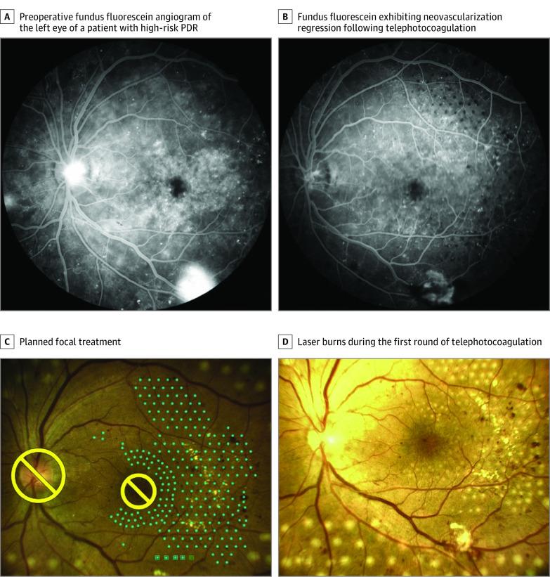 https://cdn.ncbi.nlm.nih.gov/pmc/blobs/8902/8444028/275fcc8962e5/jamaophthalmol-e212312-g003.jpg