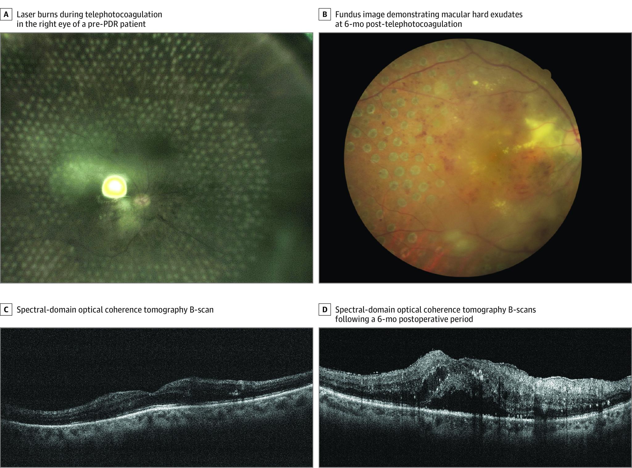 https://cdn.ncbi.nlm.nih.gov/pmc/blobs/8902/8444028/b75354c18aed/jamaophthalmol-e212312-g004.jpg