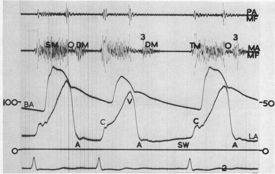 https://cdn.ncbi.nlm.nih.gov/pmc/blobs/8905/1017807/6c835e94559e/brheartj00365-0073-a.jpg