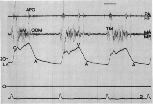 https://cdn.ncbi.nlm.nih.gov/pmc/blobs/8905/1017807/dc5fdd0661e5/brheartj00365-0078-a.jpg