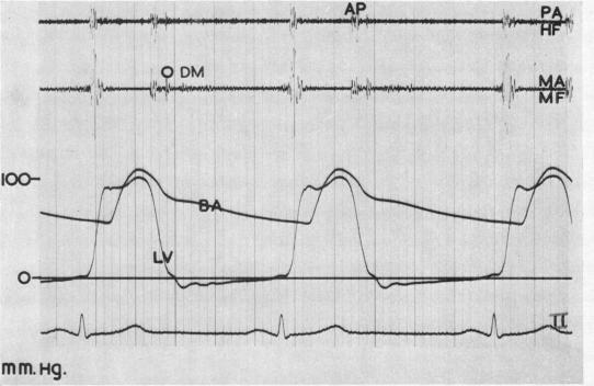 https://cdn.ncbi.nlm.nih.gov/pmc/blobs/8905/1017807/eda332688611/brheartj00365-0079-a.jpg