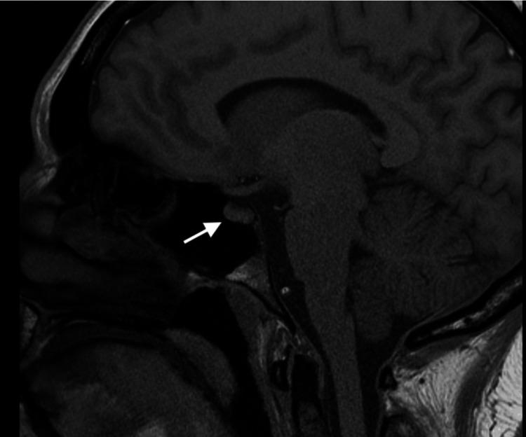 https://cdn.ncbi.nlm.nih.gov/pmc/blobs/897f/11129915/276524ca922f/cureus-0016-00000059167-i04.jpg