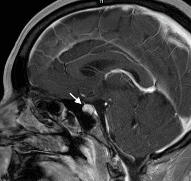 https://cdn.ncbi.nlm.nih.gov/pmc/blobs/897f/11129915/c2ccf34f34ec/cureus-0016-00000059167-i01.jpg