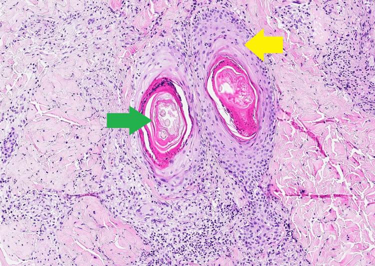 https://cdn.ncbi.nlm.nih.gov/pmc/blobs/89da/11416745/4dbc0667f96b/cureus-0016-00000067586-i05.jpg