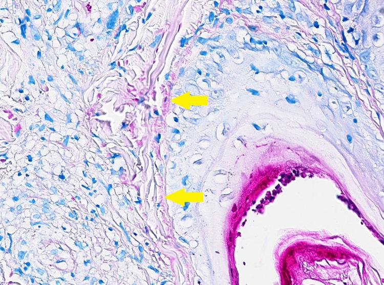 https://cdn.ncbi.nlm.nih.gov/pmc/blobs/89da/11416745/ce60ec5a8f8a/cureus-0016-00000067586-i06.jpg