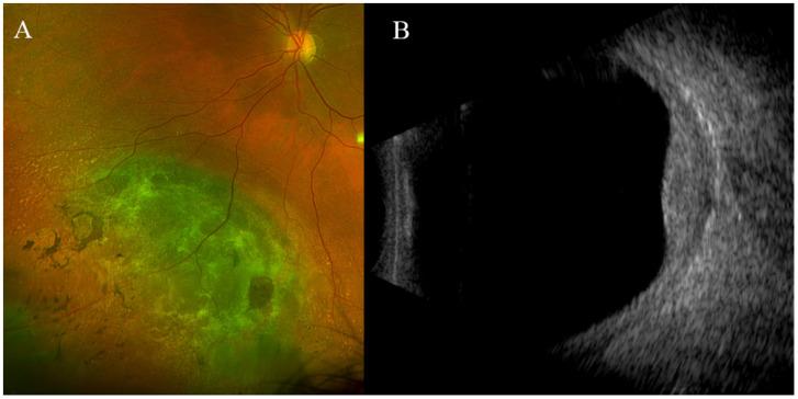 https://cdn.ncbi.nlm.nih.gov/pmc/blobs/8a57/11172988/fb55fd049dc6/jcm-13-03035-g004.jpg