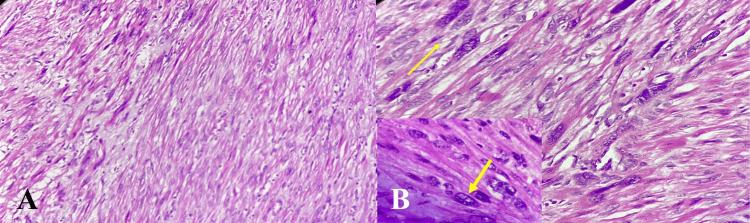 https://cdn.ncbi.nlm.nih.gov/pmc/blobs/8ac3/11622332/b3f0d8127d8a/cureus-0016-00000073115-i02.jpg