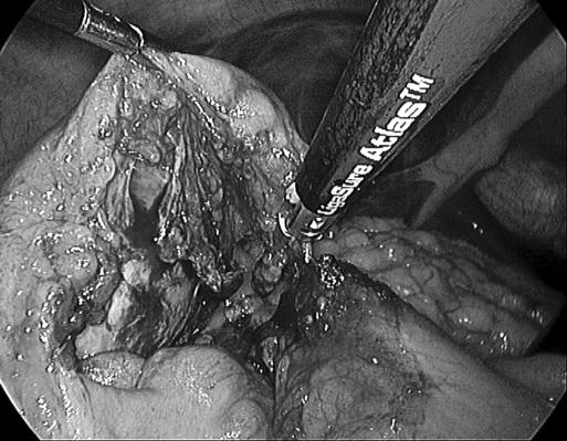 https://cdn.ncbi.nlm.nih.gov/pmc/blobs/8ad5/3016193/2661852aece1/jsls-12-2-194-g04.jpg