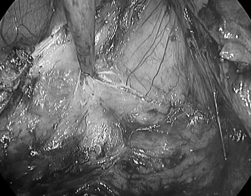 https://cdn.ncbi.nlm.nih.gov/pmc/blobs/8ad5/3016193/b8184d94b607/jsls-12-2-194-g03.jpg