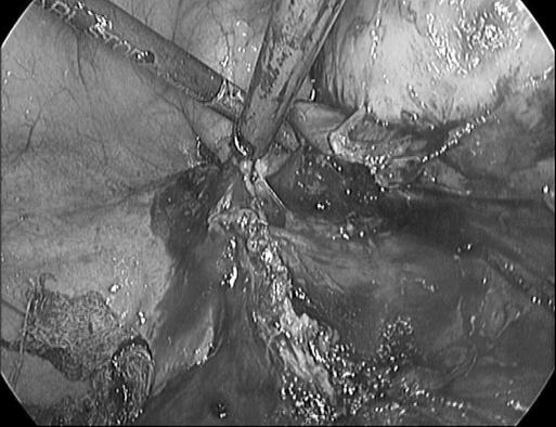https://cdn.ncbi.nlm.nih.gov/pmc/blobs/8ad5/3016193/c0a2e2934d42/jsls-12-2-194-g02.jpg