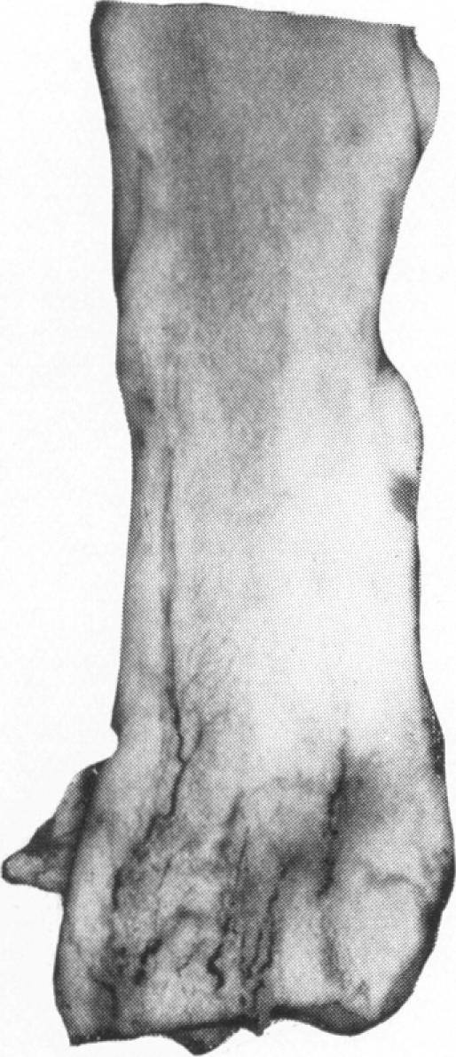 https://cdn.ncbi.nlm.nih.gov/pmc/blobs/8b03/1975545/41f92ff49b25/archdisch01481-0058-c.jpg