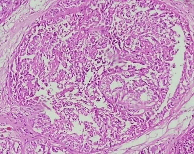 https://cdn.ncbi.nlm.nih.gov/pmc/blobs/8b5f/10309016/5f1107adb3ac/cureus-0015-00000039676-i01.jpg