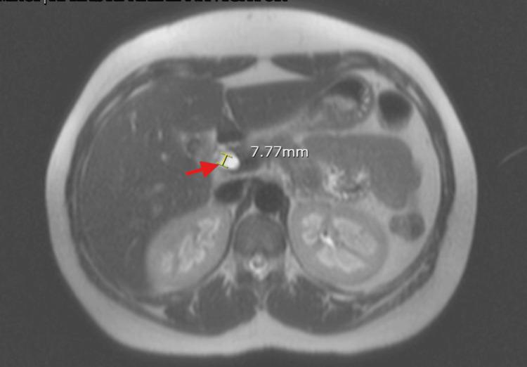 https://cdn.ncbi.nlm.nih.gov/pmc/blobs/8b82/11994046/5a46b9a506f8/cureus-0017-00000080558-i03.jpg