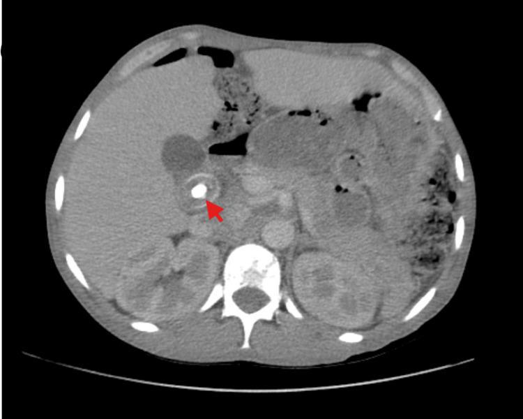 https://cdn.ncbi.nlm.nih.gov/pmc/blobs/8b82/11994046/5f871548748f/cureus-0017-00000080558-i05.jpg