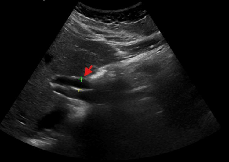 https://cdn.ncbi.nlm.nih.gov/pmc/blobs/8b82/11994046/ce96c17aa4cd/cureus-0017-00000080558-i02.jpg