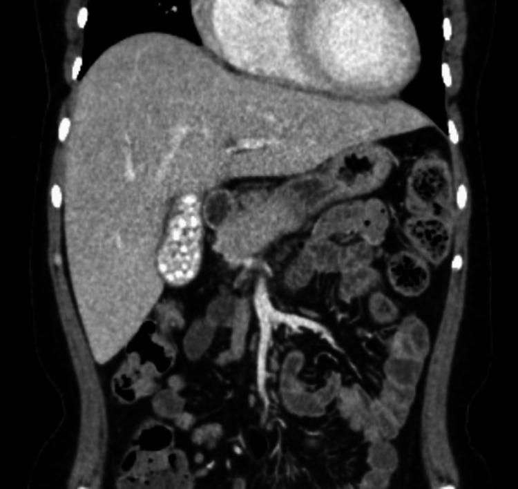 https://cdn.ncbi.nlm.nih.gov/pmc/blobs/8b82/11994046/dd12cf2535bb/cureus-0017-00000080558-i06.jpg