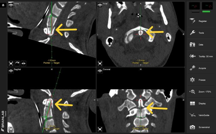 https://cdn.ncbi.nlm.nih.gov/pmc/blobs/8bdf/11638800/946ea5df8548/cureus-0016-00000073572-i05.jpg