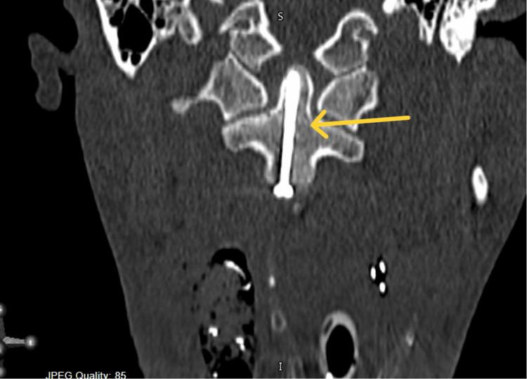 https://cdn.ncbi.nlm.nih.gov/pmc/blobs/8bdf/11638800/9983dbc22847/cureus-0016-00000073572-i08.jpg