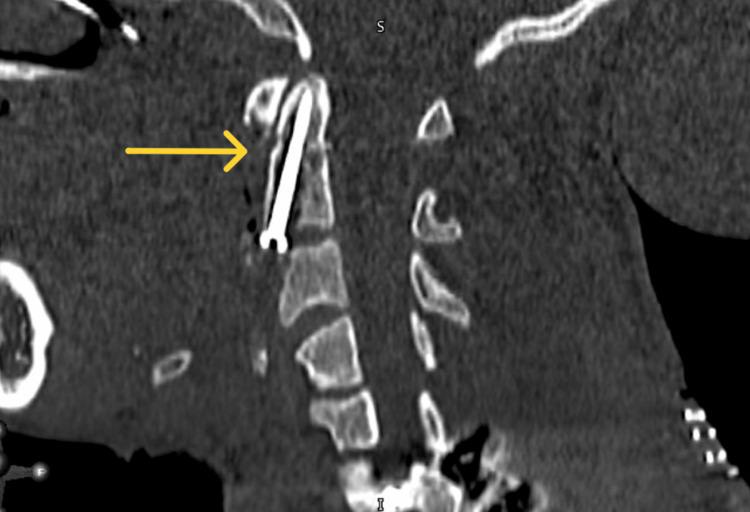 https://cdn.ncbi.nlm.nih.gov/pmc/blobs/8bdf/11638800/abc121066c20/cureus-0016-00000073572-i07.jpg
