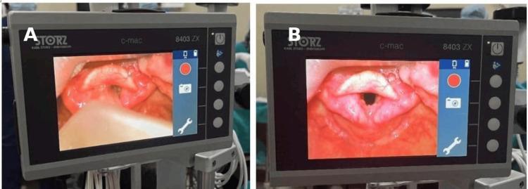 https://cdn.ncbi.nlm.nih.gov/pmc/blobs/8c1d/11378328/1189d43e6c57/cureus-0016-00000066360-i01.jpg