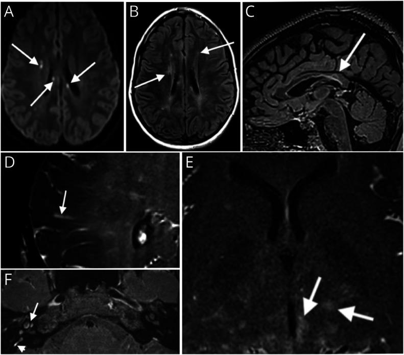 https://cdn.ncbi.nlm.nih.gov/pmc/blobs/8c22/8105894/98aa079313a9/NEURIMMINFL2021038619f1.jpg