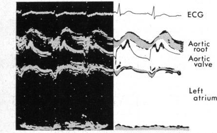 https://cdn.ncbi.nlm.nih.gov/pmc/blobs/8c39/482898/9472b86f04d6/brheartj00259-0028-b.jpg