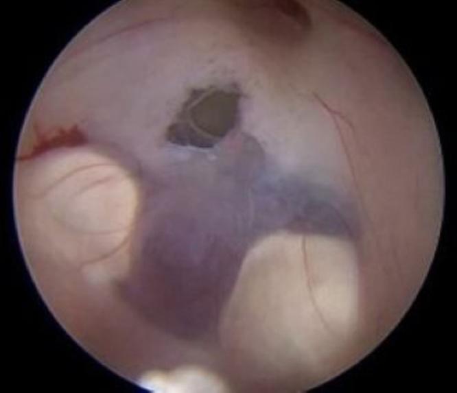 https://cdn.ncbi.nlm.nih.gov/pmc/blobs/8c49/12278952/7efcd6102867/CASE2531_figure_4.jpg