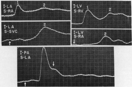 https://cdn.ncbi.nlm.nih.gov/pmc/blobs/8c94/1017800/b79f29905ebf/brheartj00365-0025-a.jpg