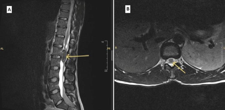 https://cdn.ncbi.nlm.nih.gov/pmc/blobs/8cb0/11447257/cad2e14e8191/cureus-0016-00000068490-i01.jpg