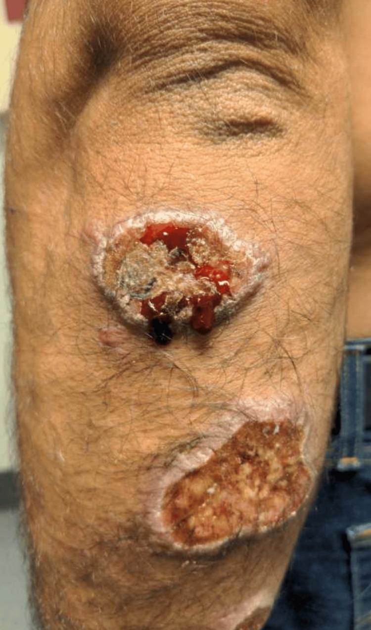 https://cdn.ncbi.nlm.nih.gov/pmc/blobs/8d53/11032212/ed82fe2b3b29/cureus-0016-00000056658-i01.jpg