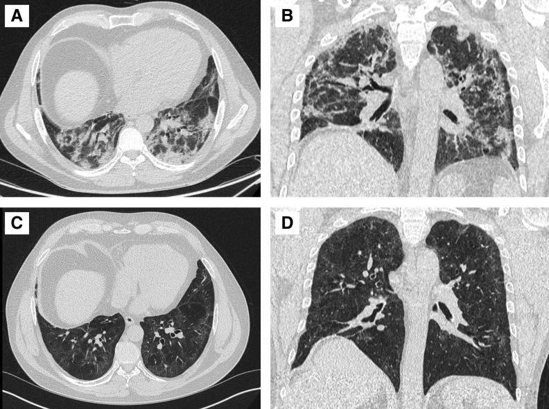 https://cdn.ncbi.nlm.nih.gov/pmc/blobs/8d5d/8086530/f6a778f00df6/AnnalsATS.202008-1002OCf4.jpg