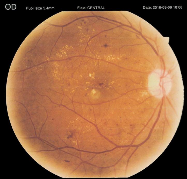 https://cdn.ncbi.nlm.nih.gov/pmc/blobs/8d63/10460237/896ce5dd91ce/mehdiophth-10-191-g004.jpg
