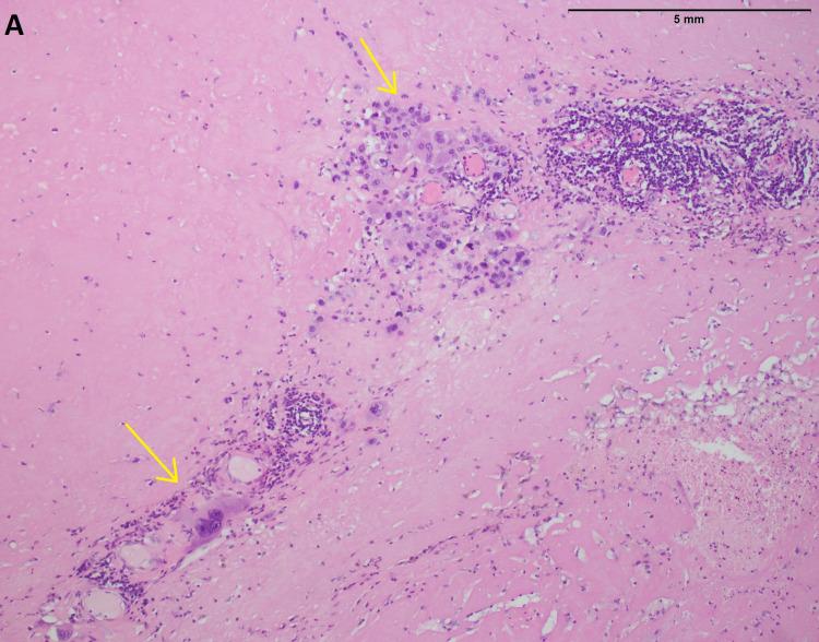 https://cdn.ncbi.nlm.nih.gov/pmc/blobs/8d71/8942161/4d3878b5cf98/cureus-0014-00000022417-i02.jpg