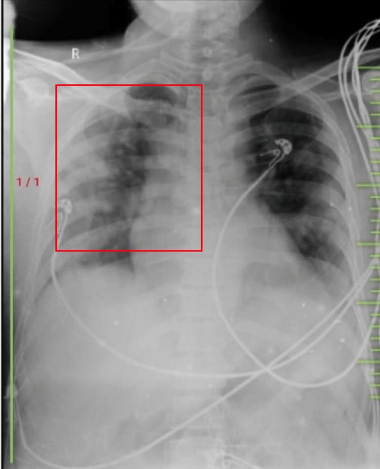 https://cdn.ncbi.nlm.nih.gov/pmc/blobs/8d7f/9848687/f2fe96402c95/cureus-0014-00000032671-i01.jpg