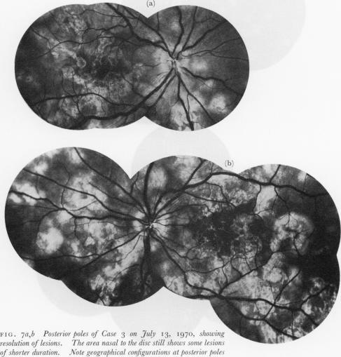 https://cdn.ncbi.nlm.nih.gov/pmc/blobs/8db0/1214795/9d5131016d24/brjopthal00300-0008-a.jpg