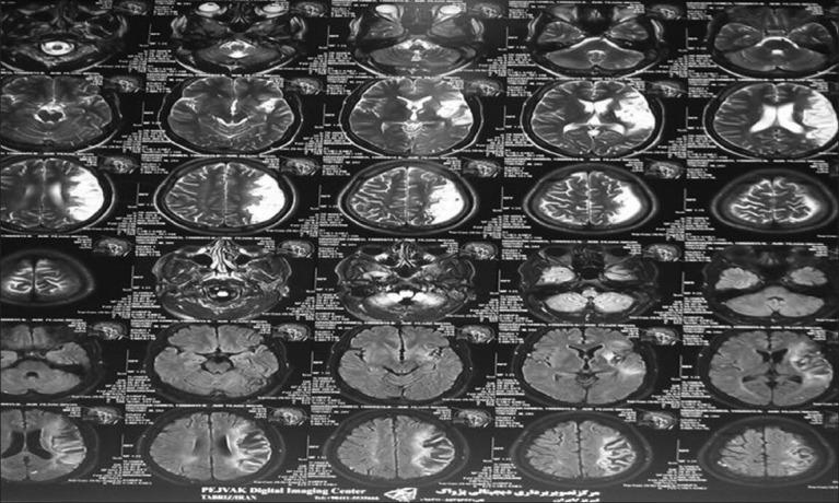 https://cdn.ncbi.nlm.nih.gov/pmc/blobs/8db6/3915464/d8797573a259/IJPVM-5-117-g005.jpg