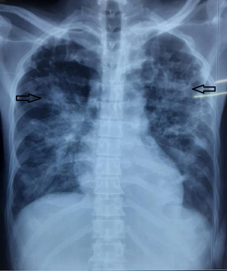 https://cdn.ncbi.nlm.nih.gov/pmc/blobs/8df3/10499062/517020bb4409/cureus-0015-00000043439-i05.jpg