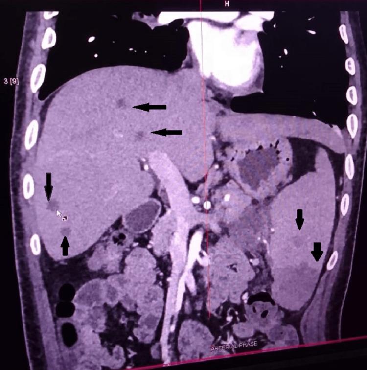 https://cdn.ncbi.nlm.nih.gov/pmc/blobs/8df3/10499062/c41d0b94a6fa/cureus-0015-00000043439-i07.jpg