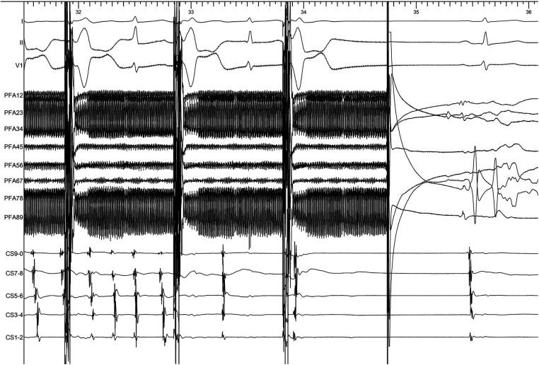 https://cdn.ncbi.nlm.nih.gov/pmc/blobs/8df5/10347413/db6b2bf07c15/fcvm-10-1211674-g002.jpg