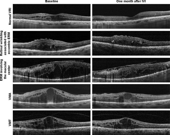 https://cdn.ncbi.nlm.nih.gov/pmc/blobs/8e91/5694203/533c1cee9a70/opth-11-1995Fig1.jpg