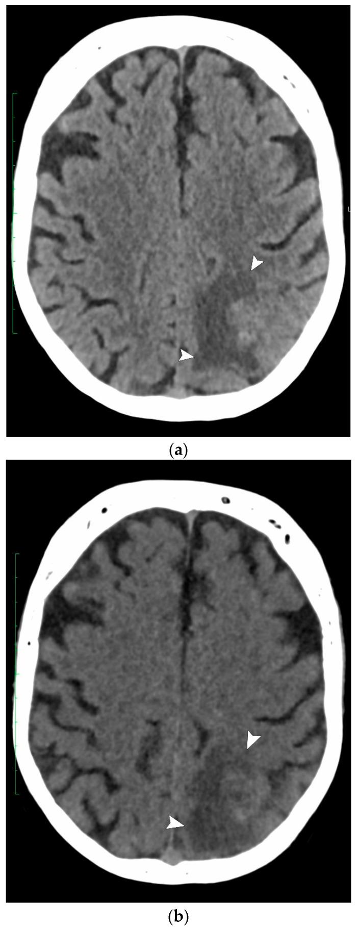 https://cdn.ncbi.nlm.nih.gov/pmc/blobs/8ec7/11242297/3098be6c9785/jcm-13-03647-g004a.jpg