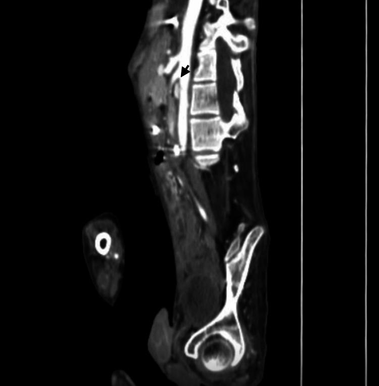 https://cdn.ncbi.nlm.nih.gov/pmc/blobs/8ede/12038874/6f9860d4fe54/cureus-0017-00000081440-i03.jpg