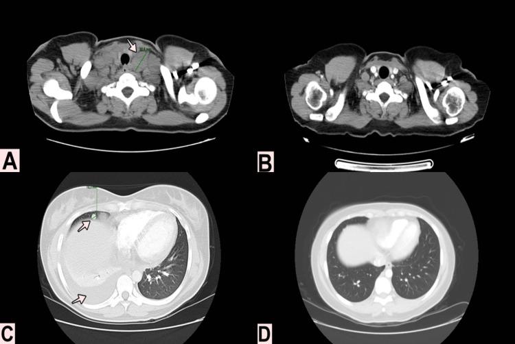https://cdn.ncbi.nlm.nih.gov/pmc/blobs/8f26/8265692/2741310432ef/cureus-0013-00000015524-i02.jpg