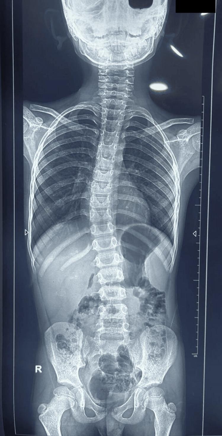 https://cdn.ncbi.nlm.nih.gov/pmc/blobs/8f30/12283090/c7656fce4934/cureus-0017-00000086551-i03.jpg