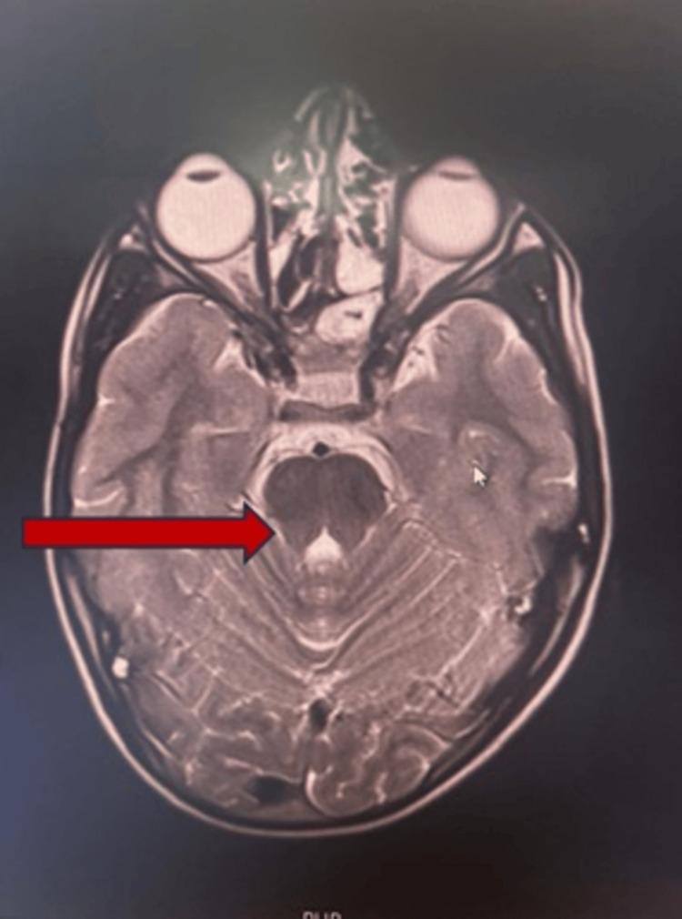 https://cdn.ncbi.nlm.nih.gov/pmc/blobs/8f30/12283090/e5b8ad720e36/cureus-0017-00000086551-i05.jpg