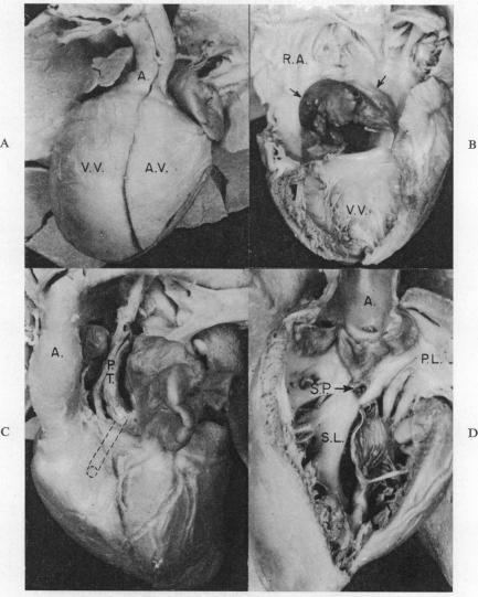 https://cdn.ncbi.nlm.nih.gov/pmc/blobs/8f60/1018190/24299ab62703/brheartj00346-0057-a.jpg