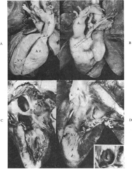 https://cdn.ncbi.nlm.nih.gov/pmc/blobs/8f60/1018190/80102303eebc/brheartj00346-0058-a.jpg