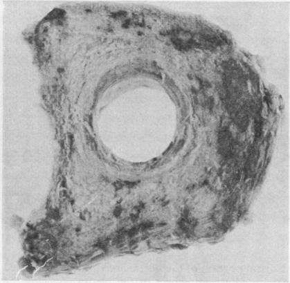 https://cdn.ncbi.nlm.nih.gov/pmc/blobs/8f7d/476724/e3bfded871db/jclinpath00171-0087-b.jpg